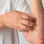 Registran primera muerte por sarampión en CDMX; caso se registró en 2025